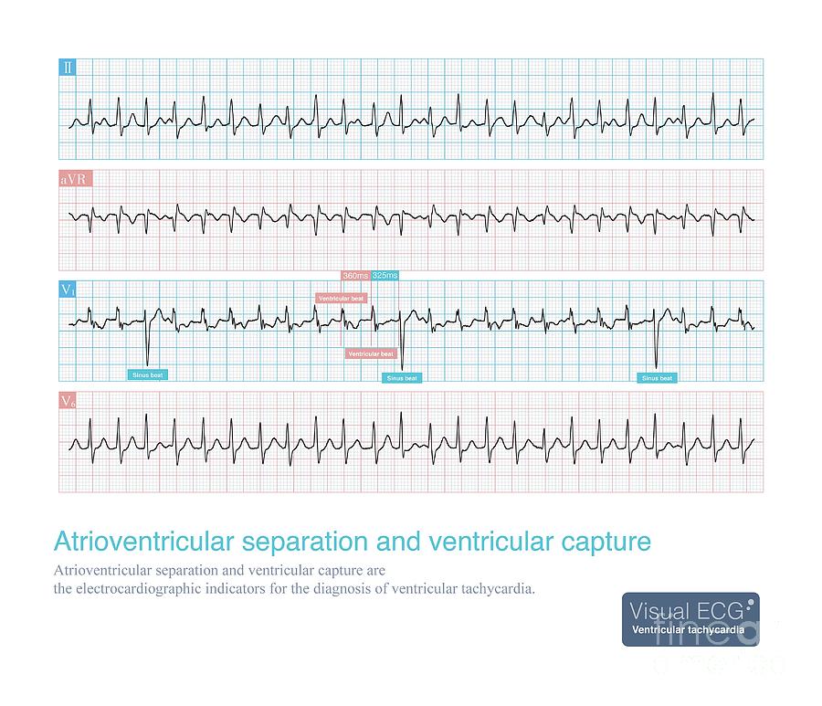 Atrioventricular Separation And Ventricular Capture Photograph by ...