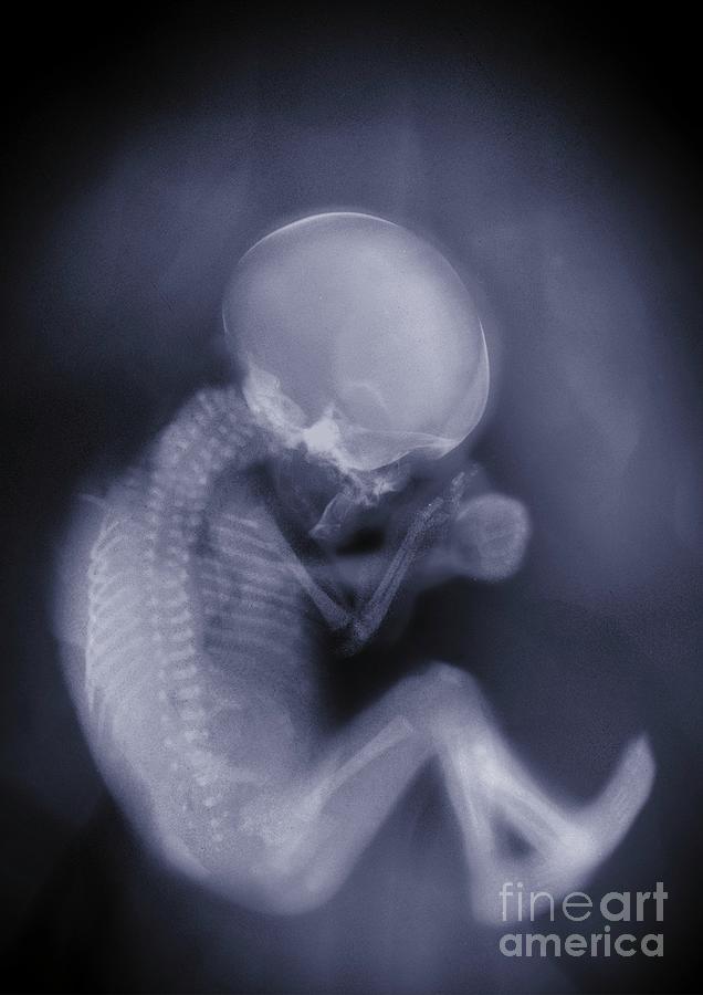 Baby In A Fetal Position Photograph by Nick Veasey/science Photo Library