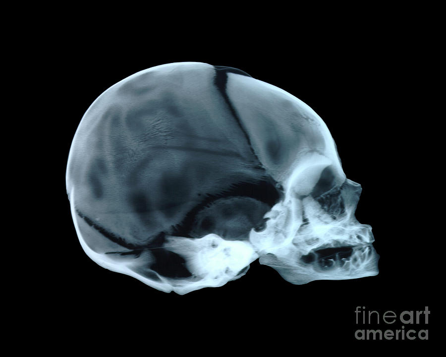 Babys Skull Photograph by D. Roberts/science Photo Library