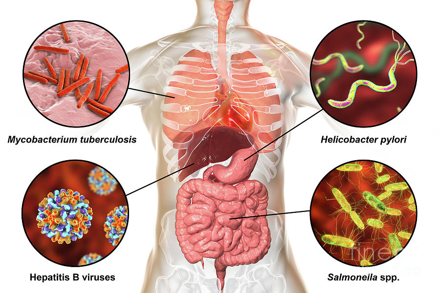 Bacteria helicobacter pylori que no comer