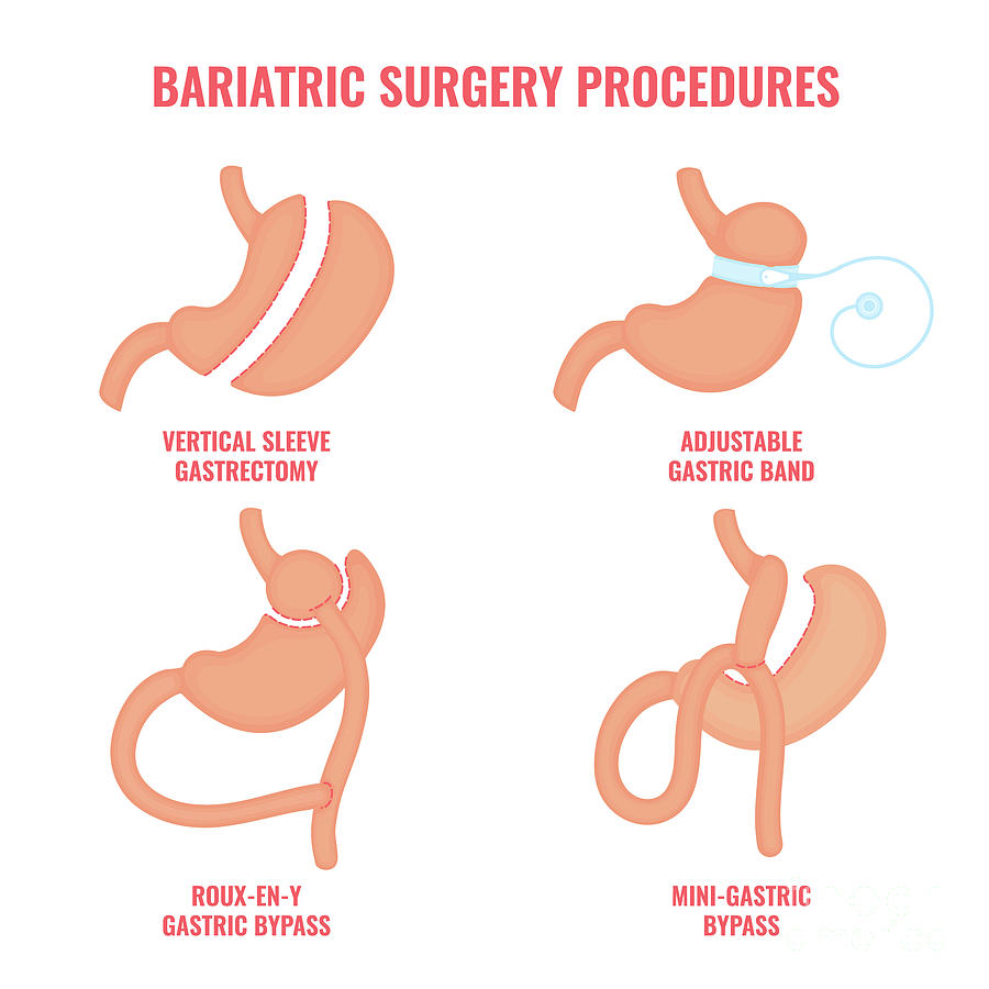 Bariatric Surgery Types Photograph By Art4stockscience Photo Library Pixels 