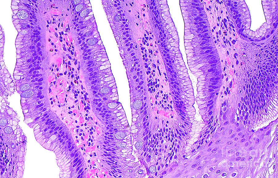 Barrett’s Oesophagus by Ziad M. El-zaatari/science Photo Library