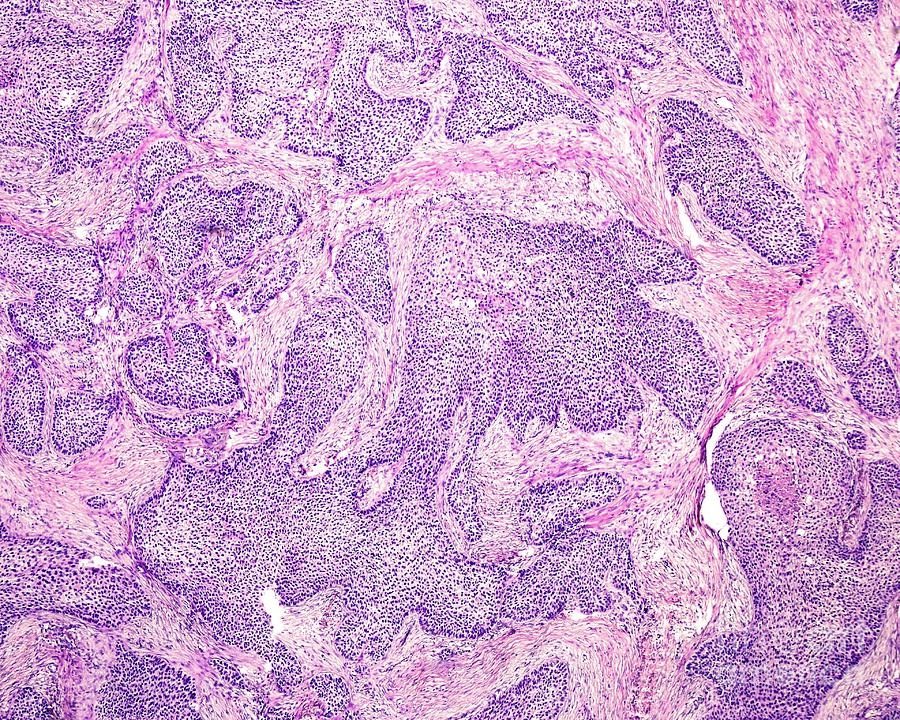 Basaloid Squamous Cell Carcinoma by Jose Calvo / Science Photo Library