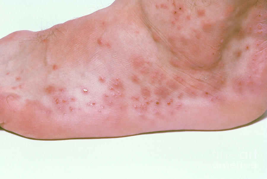 Bed Bug Bites On Persons Foot Photograph By Science Photo Library