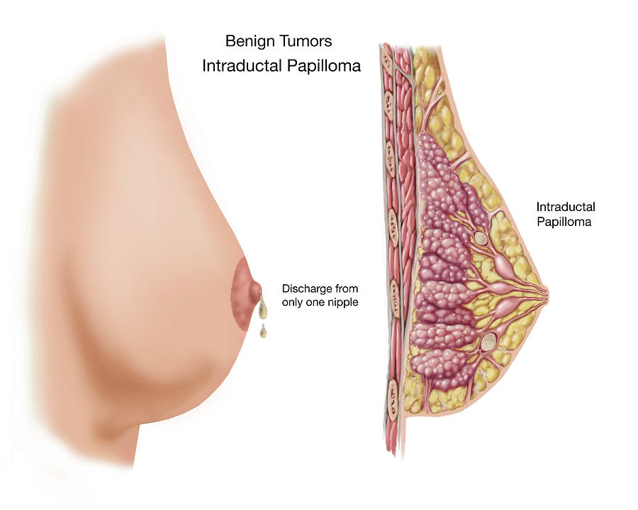 What is benign papilloma. Intraductal papilloma in situ