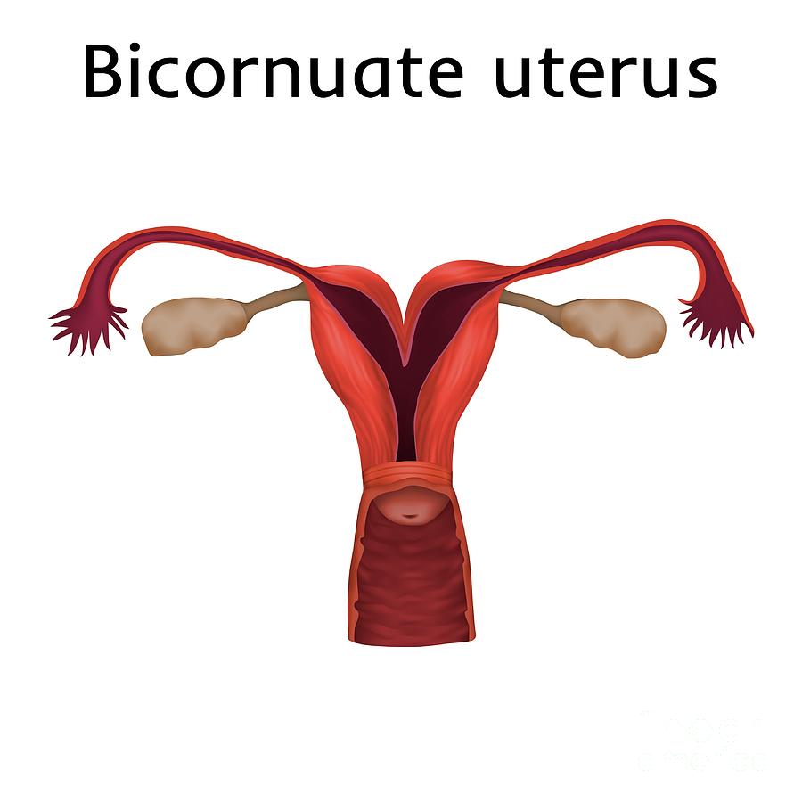 Bicornuate Uterus Photograph by Veronika Zakharova/science Photo Library