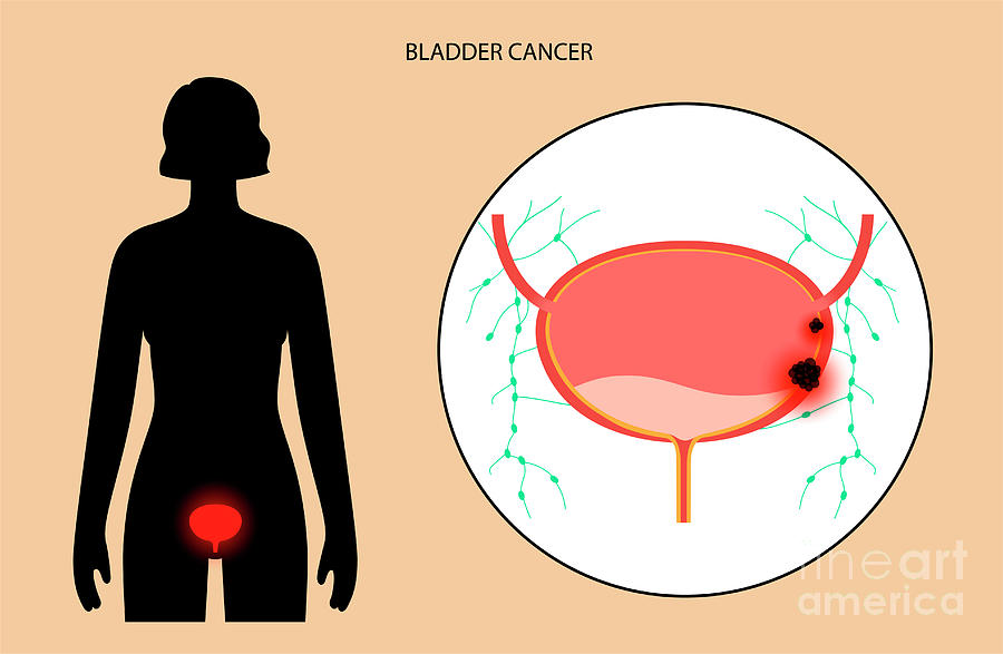 Bladder Cancer Stages Photograph by Pikovit / Science Photo Library ...