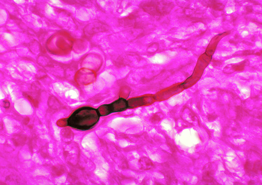 Blastomyces Dermatitidis Photograph by Science Source