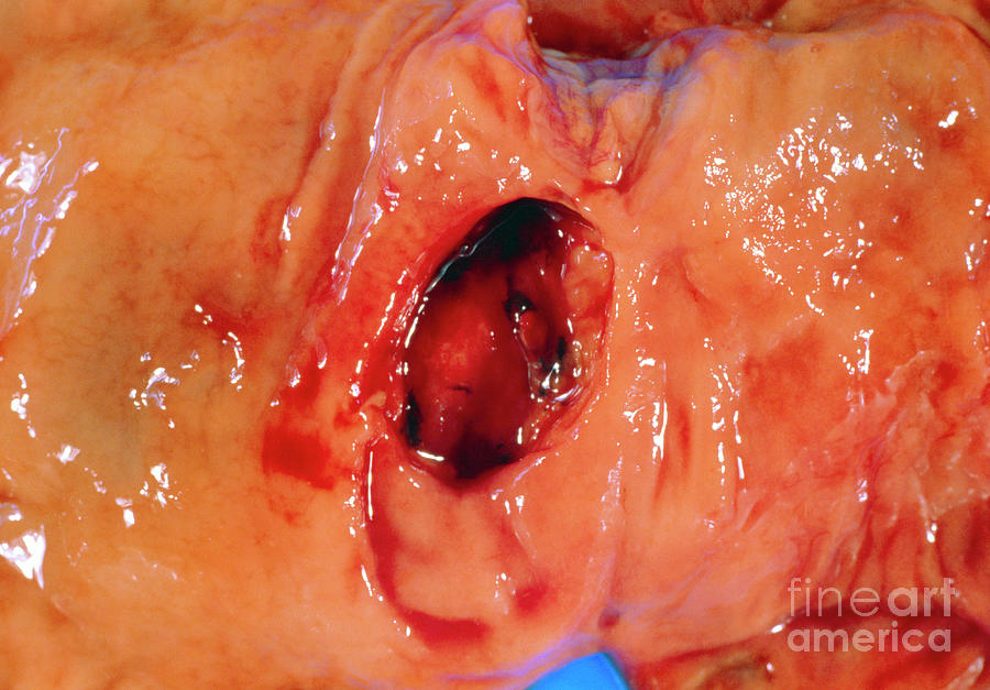Gastric Ulcer Photograph - Bleeding Gastric Ulcer In Excised Part Of Stomach by Dr. E. Walker/science Photo Library