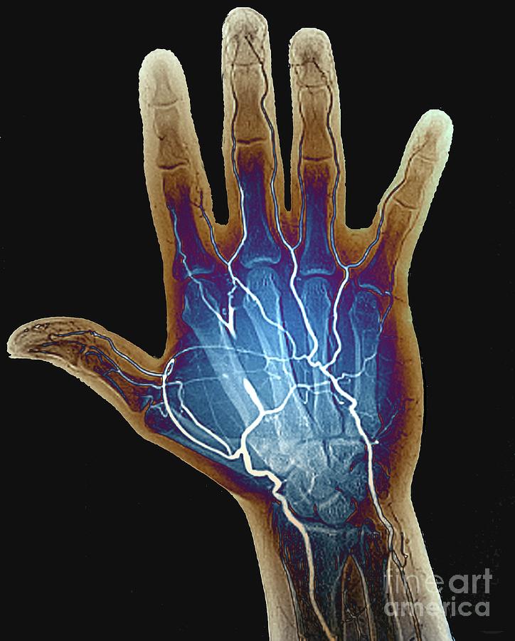 Blocked Hand Artery Photograph by Zephyr/science Photo Library