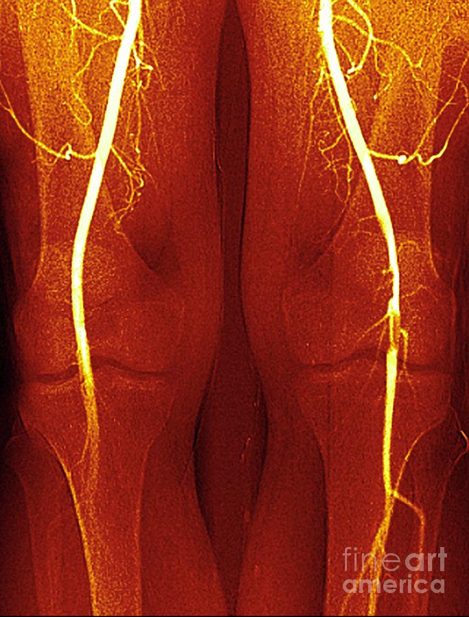 Blocked Knee Artery Photograph by Zephyr/science Photo Library