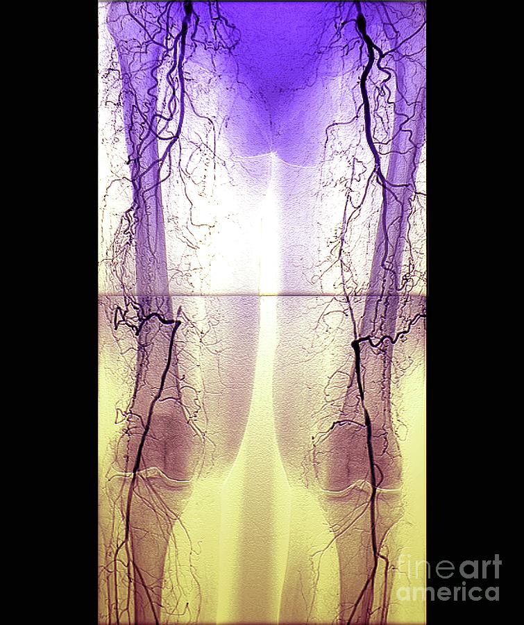 Blocked Leg Arteries Photograph By Zephyrscience Photo Library Fine Art America 1606