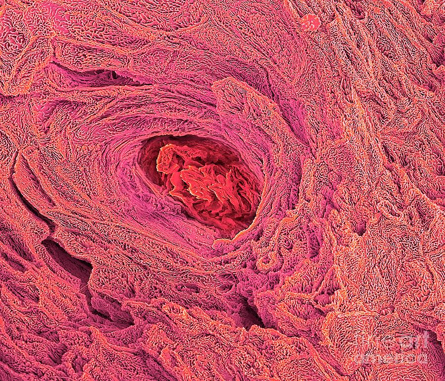Blocked Sweat Gland Photograph by Steve Gschmeissner/science Photo Library