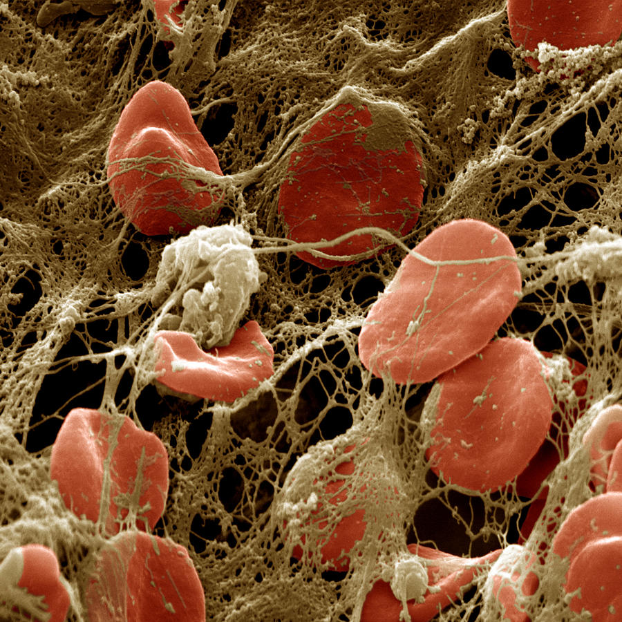 Blood Clot Photograph by Oliver Meckes EYE OF SCIENCE