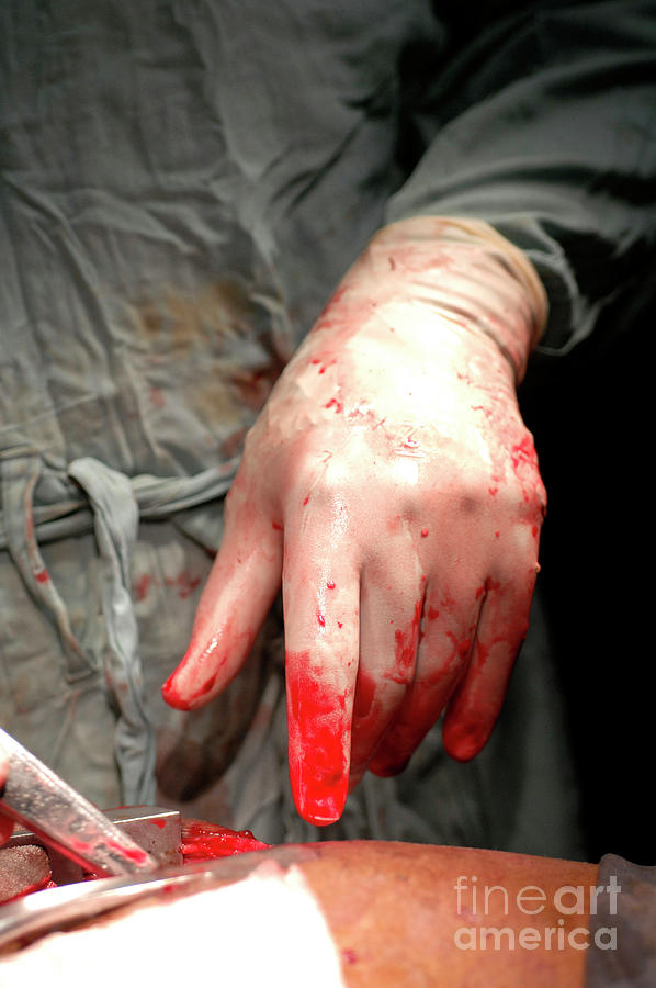 Blood-stained Surgical Glove Photograph by Medicimage / Science Photo Library