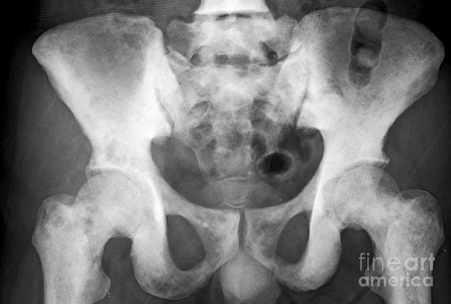 Bone Metastasis Of The Pelvis Photograph by Rajaaisya/science Photo Library