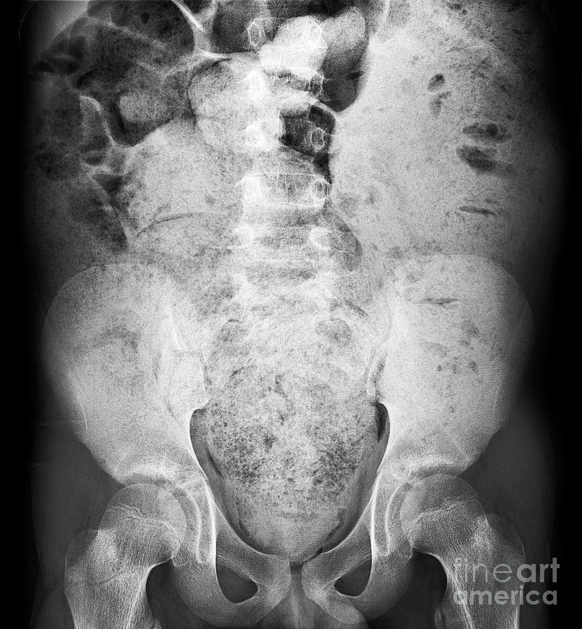 Bowel Obstruction Photograph by Science Photo Library