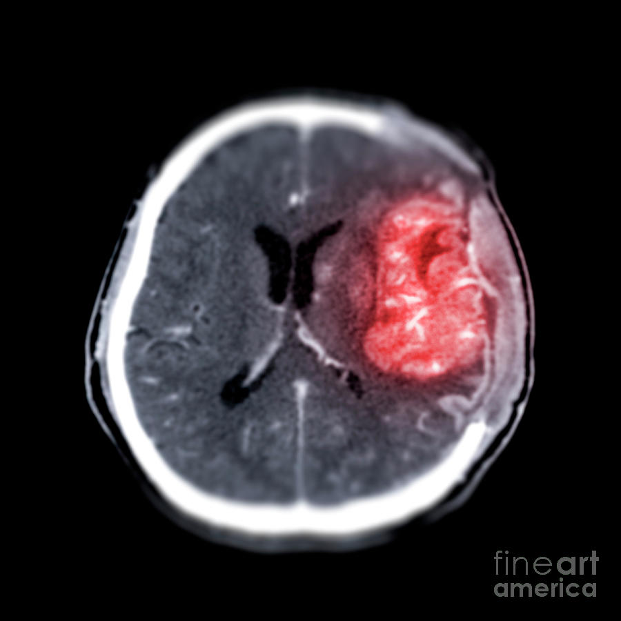 Brain After Brain Tumor Surgery Photograph by Samunella/science Photo Library