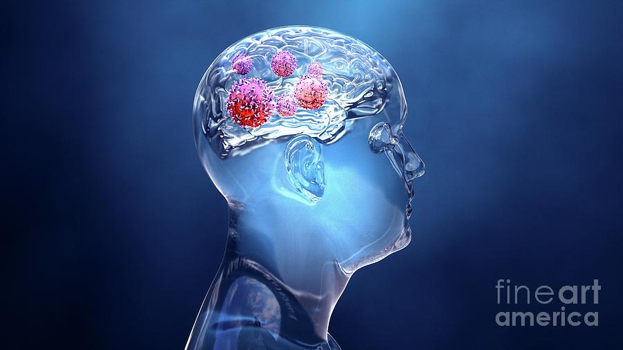 Brain Cancer Photograph By Design Cells Science Photo Library Fine