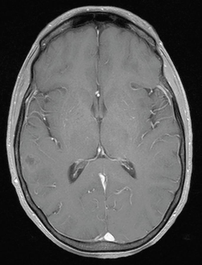 Brain Cancer Treated, Mri Photograph by Steven Needell