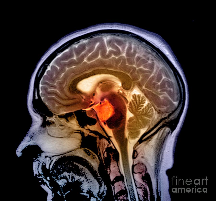 Brain Cyst Photograph by Simon Fraser/science Photo Library
