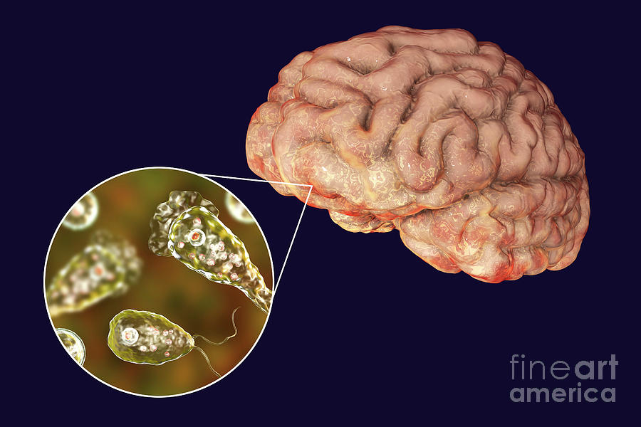 Brain-eating Amoeba Infection Photograph By Kateryna Kon/science Photo ...