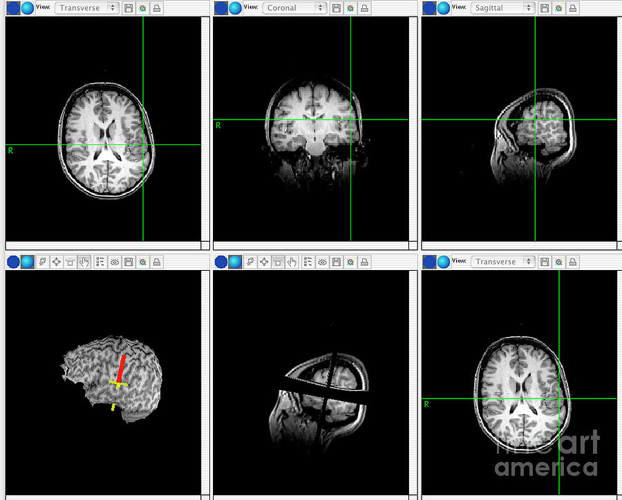 Brain Mapping Scans Photograph by Simon Fraser/science Photo Library