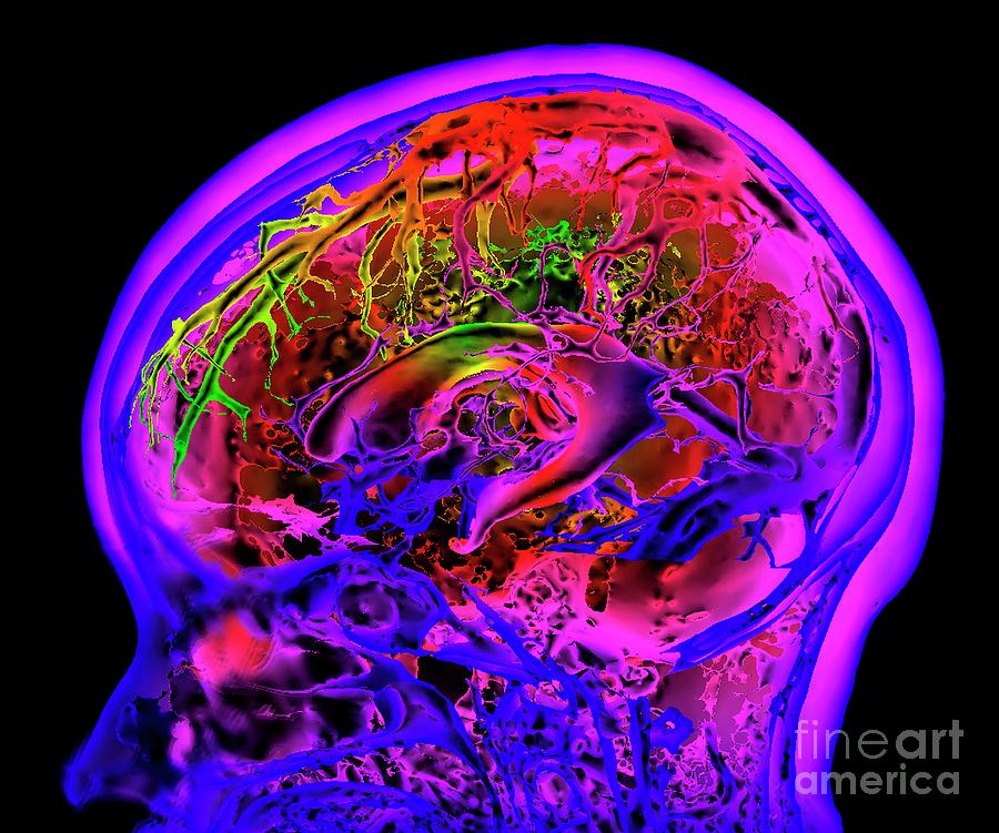 Blood Vessel Photograph - Brain Ventricles And Veins by K H Fung/science Photo Library Blood Vessel Photograph - Brain Ventricles And Veins by K H Fung/science Photo Library