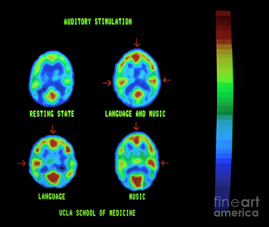 Brain When Hearing Photograph by Dr John Mazziotta Et Al/neurology/science Photo Library