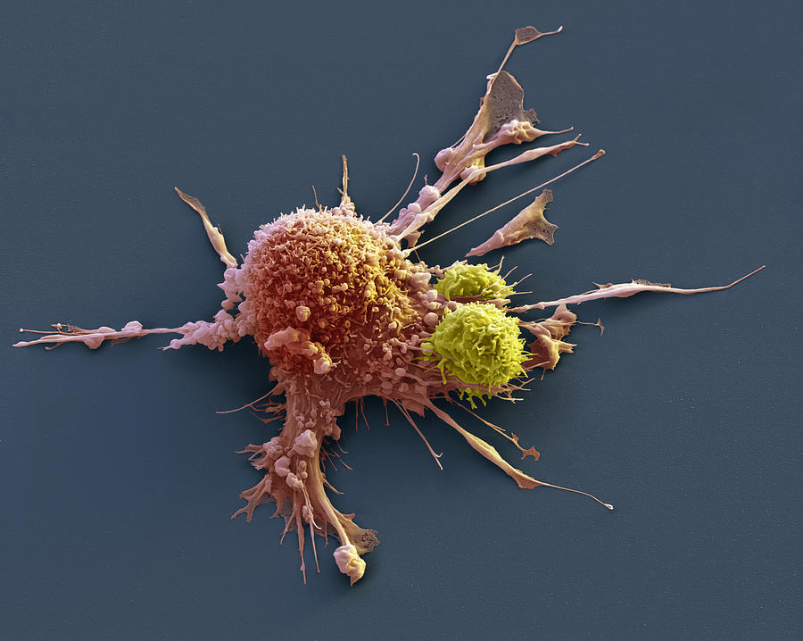 Breast Cancer Cell With Car-t Cells, Sem Photograph by Oliver Meckes EYE OF SCIENCE