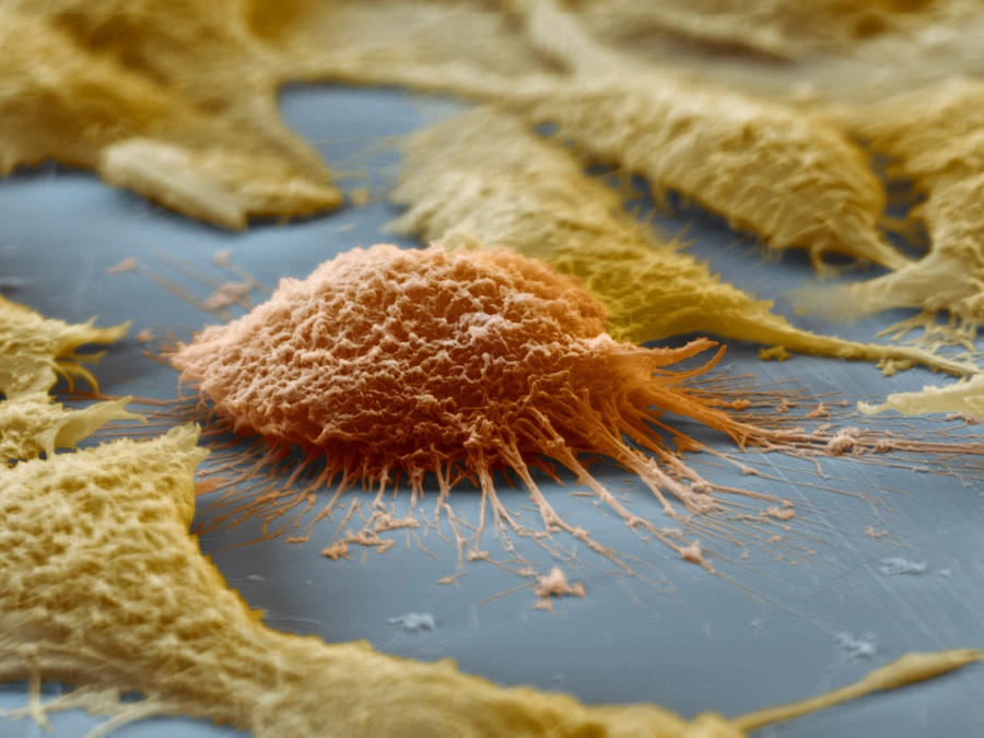 Breast Cancer Cells Photograph by Meckes/ottawa