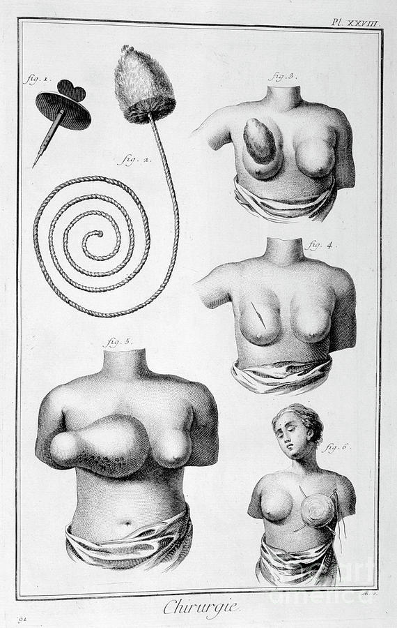 Breast Surgery, 1751-1777 Drawing by Print Collector