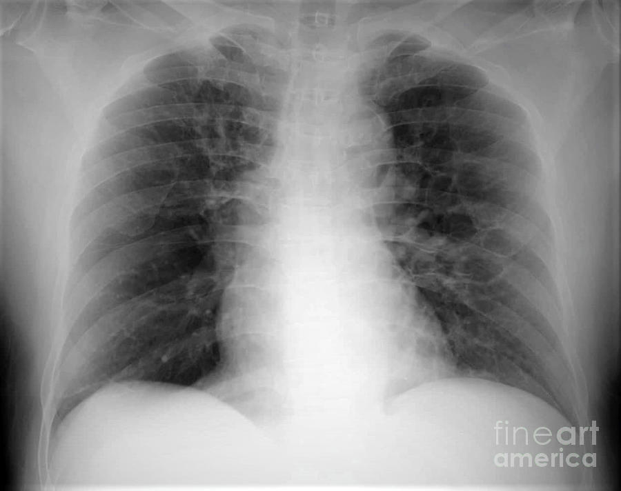 Bronchiectasis Photograph by Rajaaisya/science Photo Library