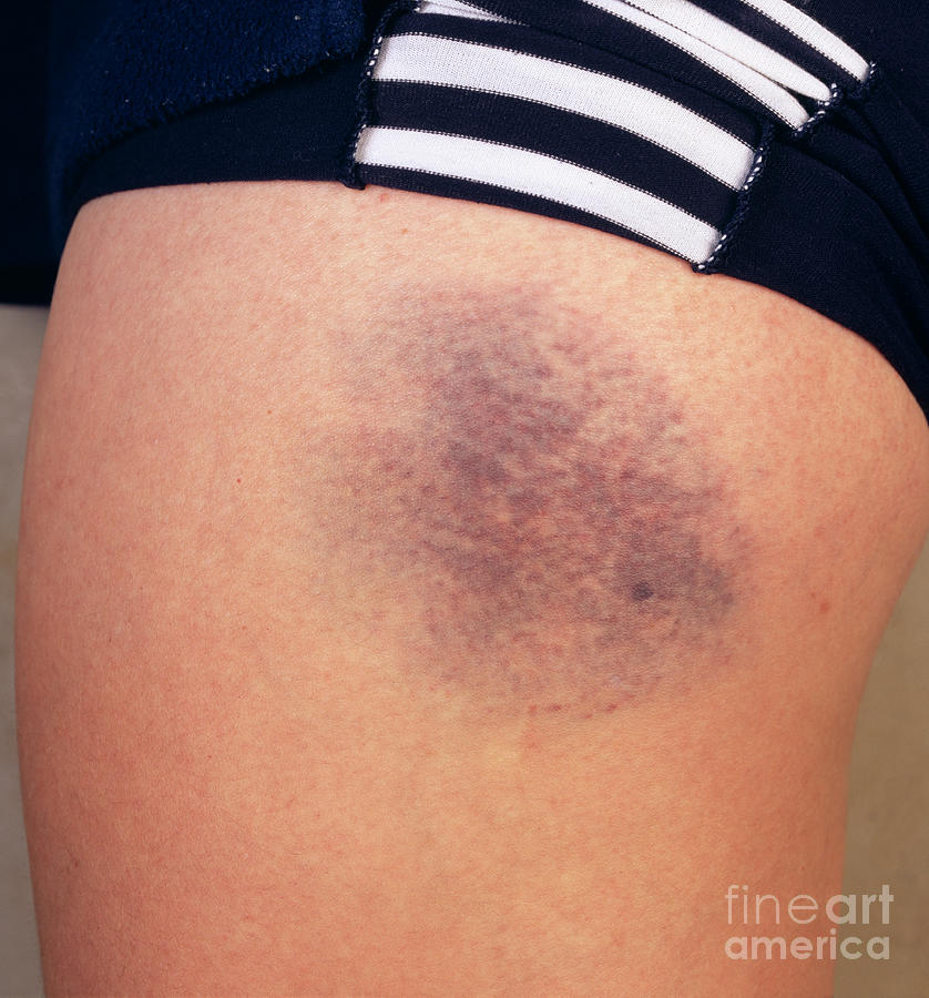Bruised Leg Photograph By Cordelia Molloyscience Photo Library Pixels