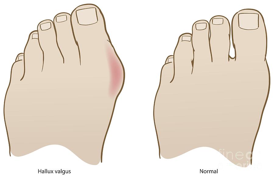 Bunion And Healthy Foot Photograph By Jeanette Engqvist Science Photo Library Pixels