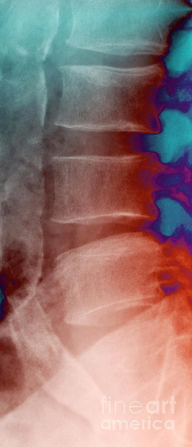 Calcified Aorta Photograph by Zephyr/science Photo Library