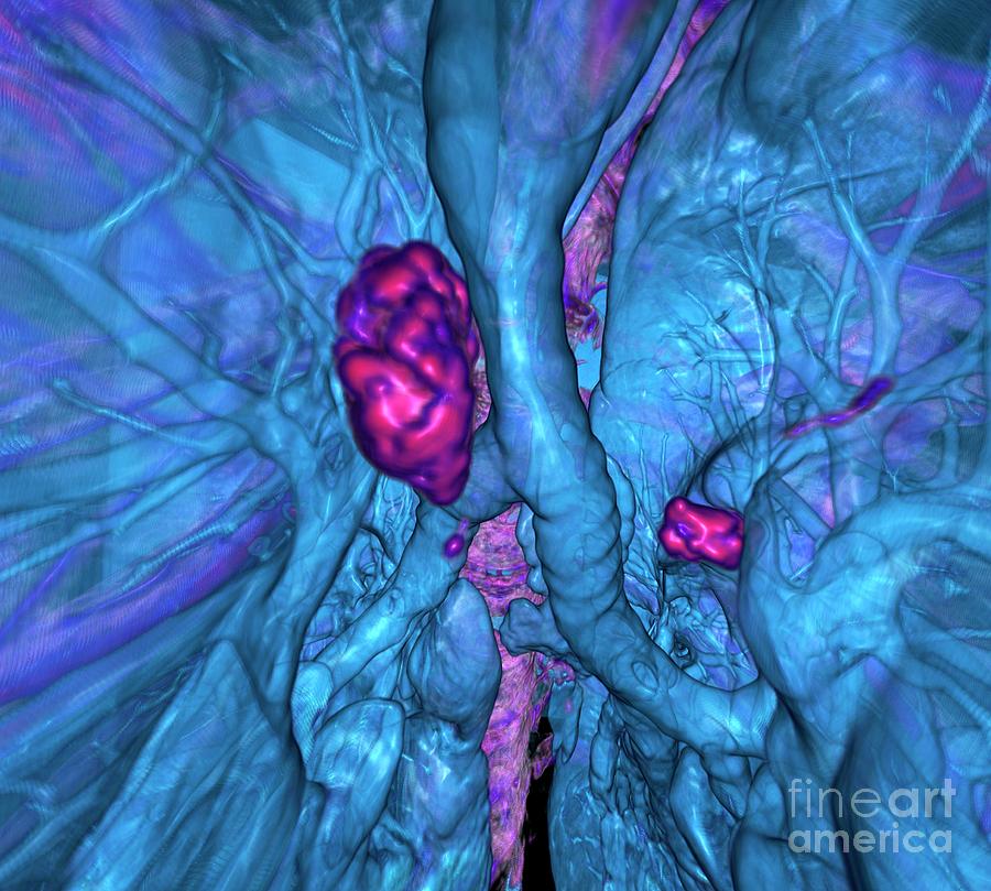 Calcified Lung Lymph Nodes Photograph by K H Fung/science Photo Library
