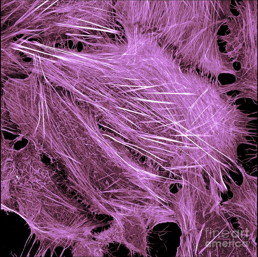 Cancer Cell Showing Actin Cytoskeleton Photograph by Howard Vindin, The University Of Sydney/science Photo Library