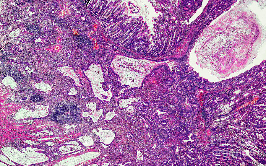 Carcinoma Of The Colon by Nigel Downer/science Photo Library