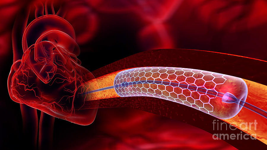 Cardiac Catheter With Stent Photograph by Norbert Zappold / Science Photo Library Pixels