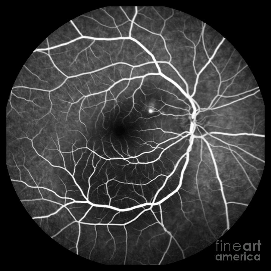 Central Serous Retinopathy by Alan Frohlichstein/science Photo Library