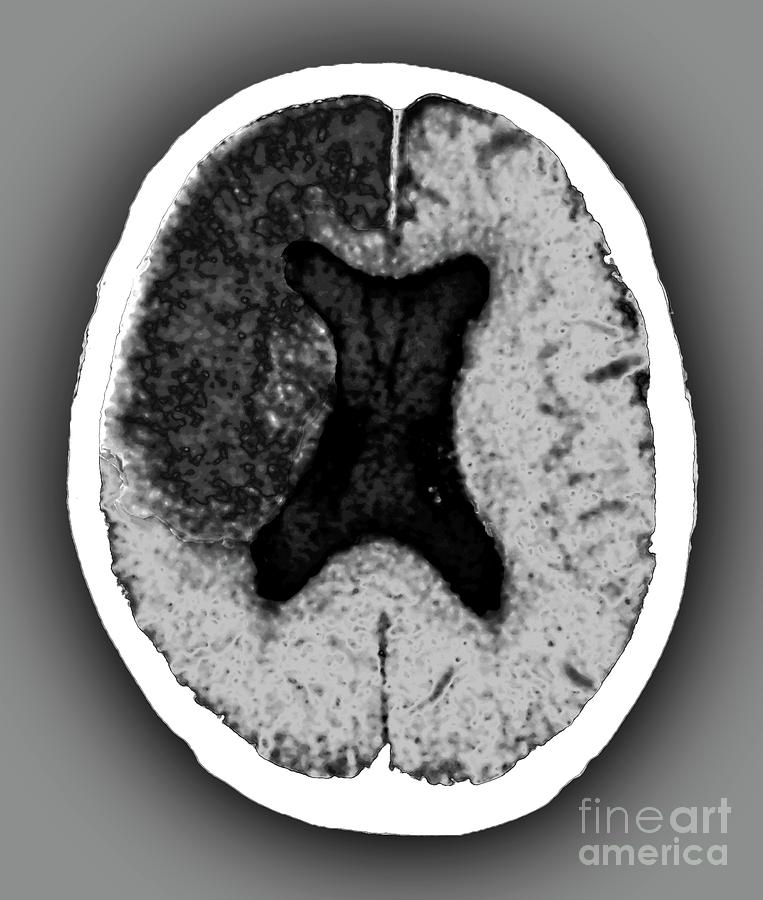 Cerebral Infarction Photograph by Zephyr/science Photo Library