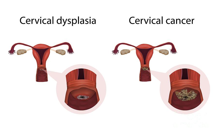 Cervical Dysplasia And Cervical Cancer Photograph by Veronika Zakharova ...