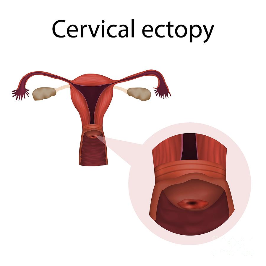 Cervical Ectopy Photograph by Veronika Zakharova/science Photo Library