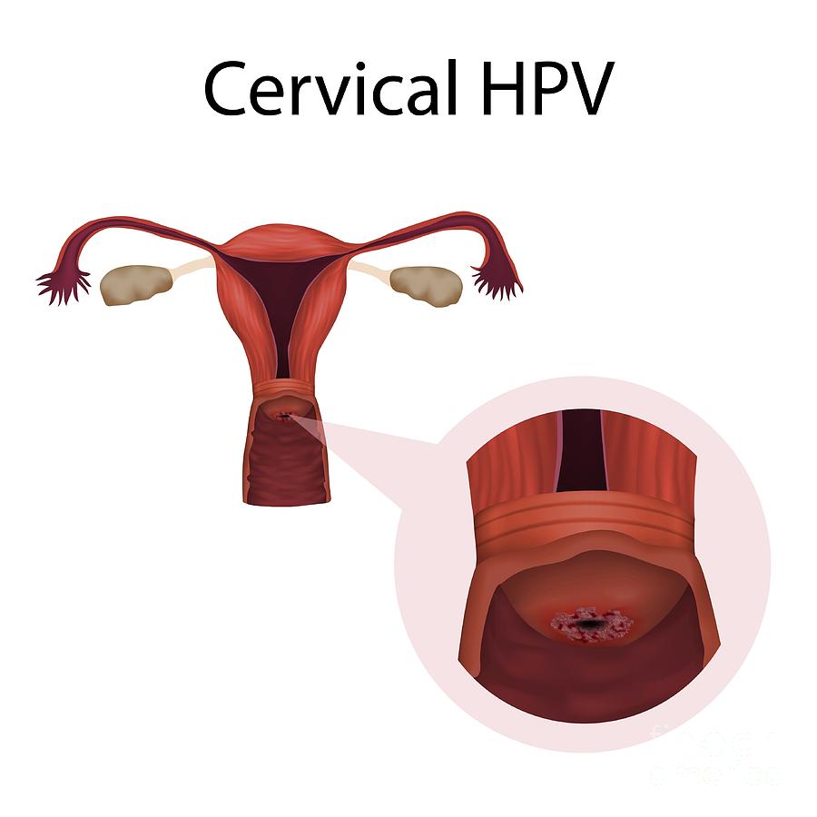 Cervical Hpv Infection Photograph By Veronika Zakharovascience Photo Library 