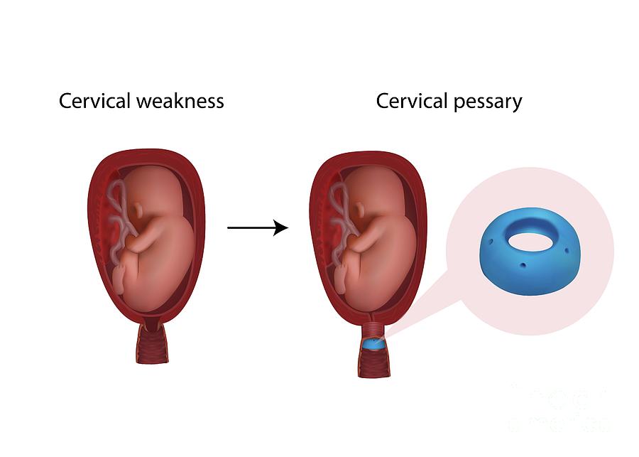 Cervical Pessary Photograph By Veronika Zakharova Science Photo Library