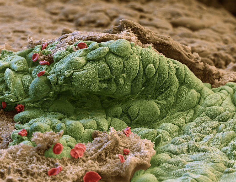 Cervical Polyp, Sem Photograph by Oliver Meckes EYE OF SCIENCE Fine