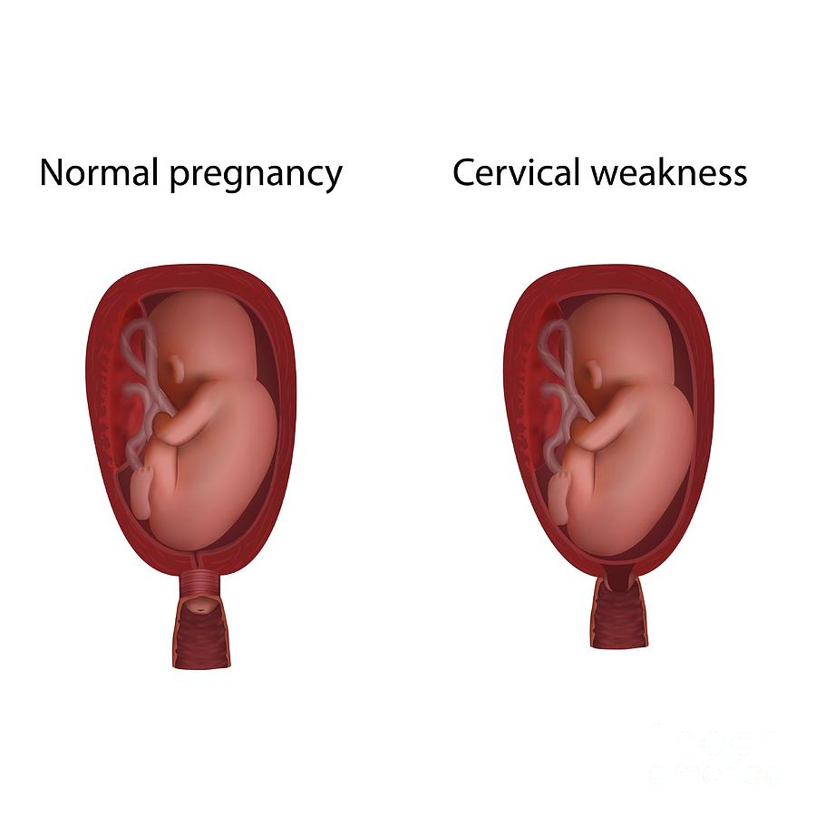 Cervical Weakness And Normal Pregnancy Photograph by Veronika Zakharova ...