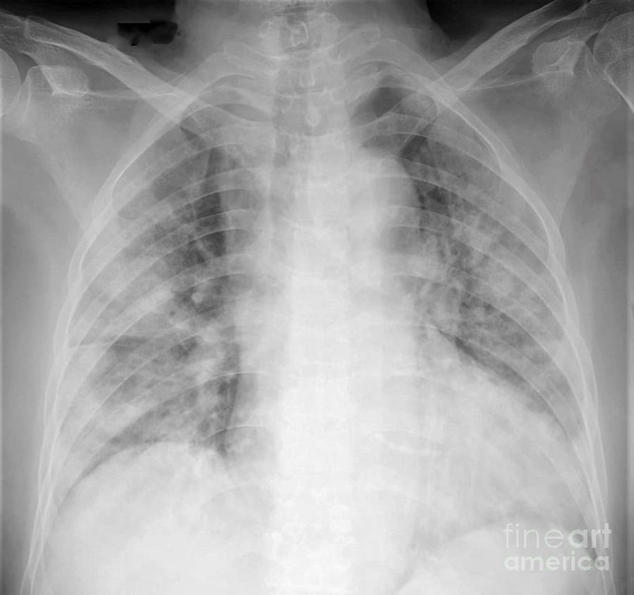 Chest X-ray Of Covid 19 Pneumonia Photograph by Rajaaisya/science Photo ...