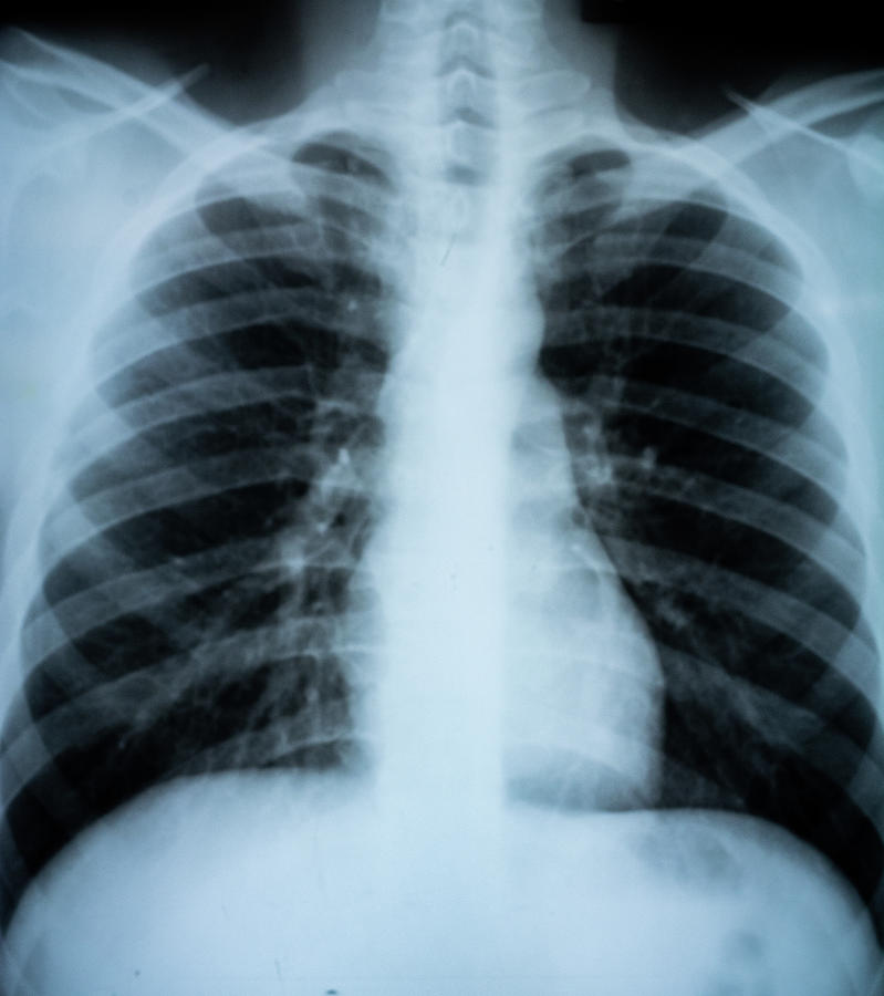 Chest X-ray, Ventral View Photograph by Richard J. Green | Pixels